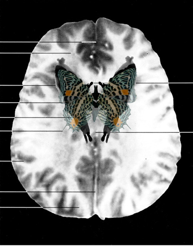 Anker_MRI Butterfly_detail.jpg